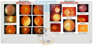 Common optic disc signs