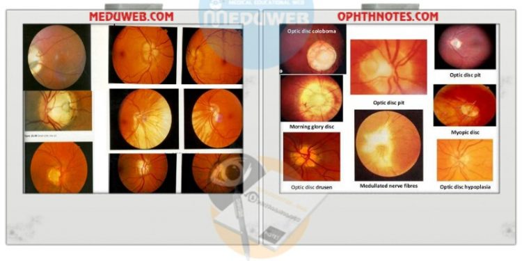 Common optic disc signs