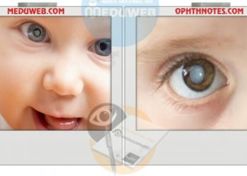 Pediatric cataracts
