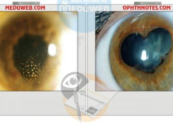 Phacoemulsification is scheduled on Uveitic patients