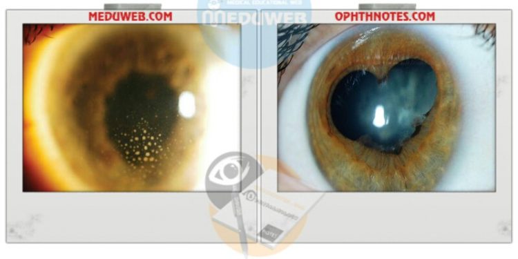 Phacoemulsification is scheduled on Uveitic patients