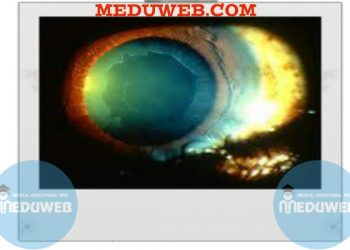 Pseudo exfoliation syndrome facts