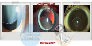 Lens subluxation syndromes