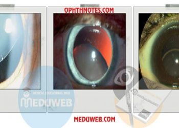 Lens subluxation syndromes