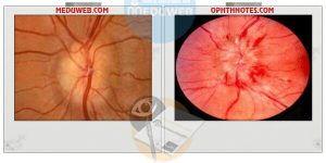 True and pseudo optic disc oedema facts