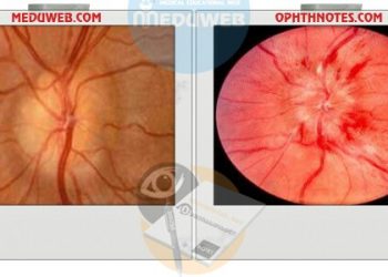 True and pseudo optic disc oedema facts