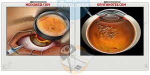 Drugs for intravitreal injection in endophthalmitis