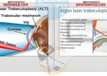 Argon laser trabeculoplasty