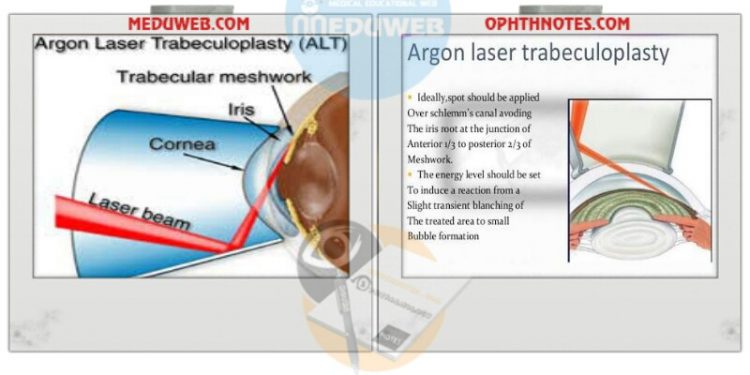 Argon laser trabeculoplasty