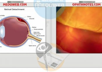 Alarms of Retinal Detachment