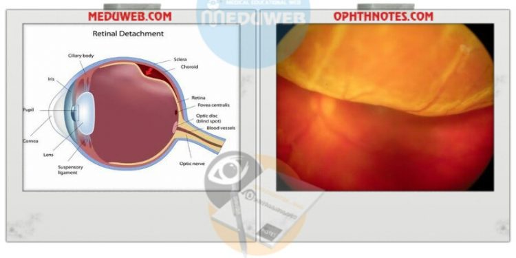 Alarms of Retinal Detachment