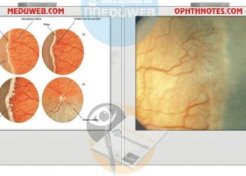 Retinopathy of Prematurity