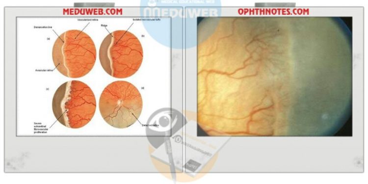 Retinopathy of Prematurity