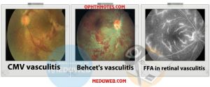 Retinal vasculitis