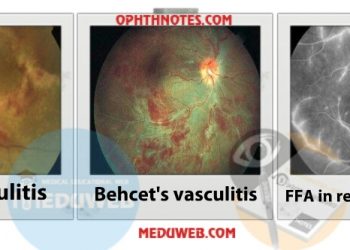 Retinal vasculitis