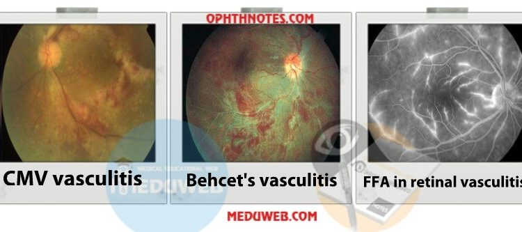 Retinal vasculitis