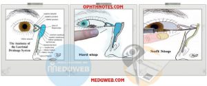 Nasolacrimal duct Syringing and Probing