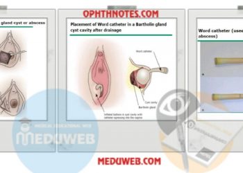 Management of Bartholin Cyst and Abscess