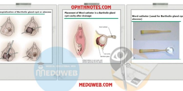 Management of Bartholin Cyst and Abscess