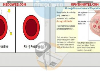 Management of Pregnant Women RH incompatibility