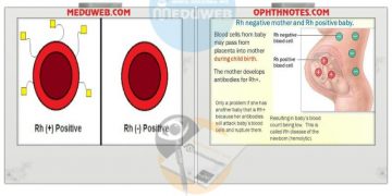 Management of Pregnant Women RH incompatibility
