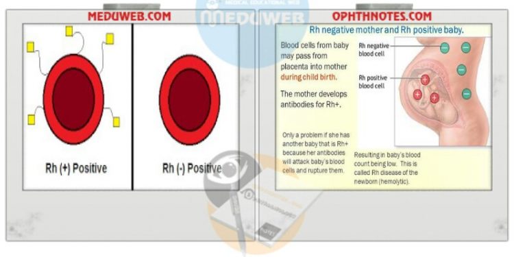 Management of Pregnant Women RH incompatibility