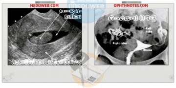 Management of Recurrent pregnancy loss (RPL) or Recurrent Abortion
