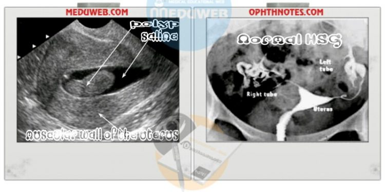 Management of Recurrent pregnancy loss (RPL) or Recurrent Abortion
