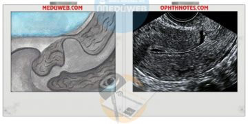 Cesarean Scar Defect