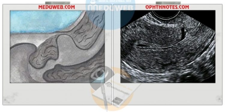 Cesarean Scar Defect