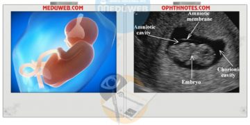Management of Oligohydramnious