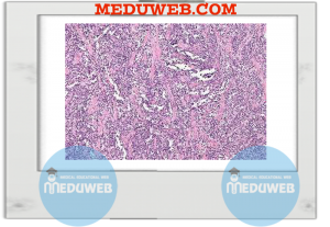 Facts of Rhabdomyosarcoma