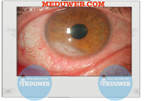 peripheral corneal thinning