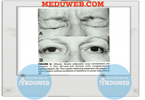 Blepharospasm