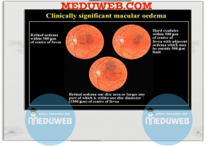 Diabetic eye disease