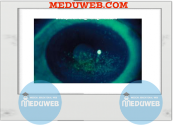 Corneal signs aids to diagnosis capsule