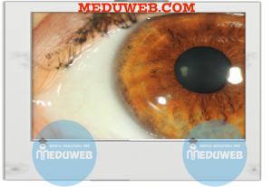 Axenfeld-Rieger syndrome(ARS)