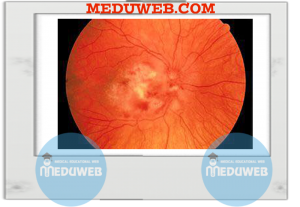 Cytomegalovirus