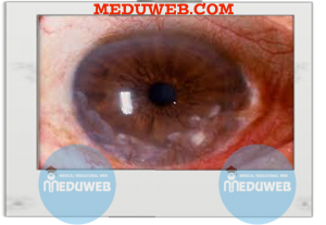peripheral corneal thinning