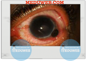 peripheral corneal thinning