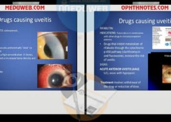 Drug-induced uveitis