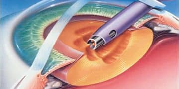 Phacoemulsification course videos