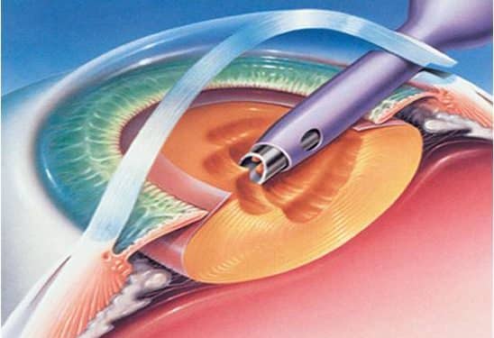 Phacoemulsification course videos