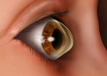 Keratoconus