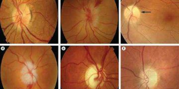 Optic Neuropathy