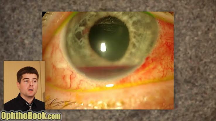 Exploding Eye Lecture by Tim Root video