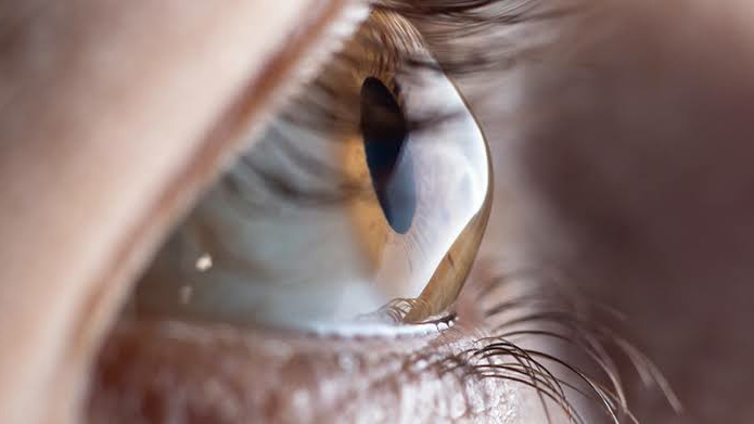 keratoconus: munson sign, rizzuti sign, oil droplet reflex video