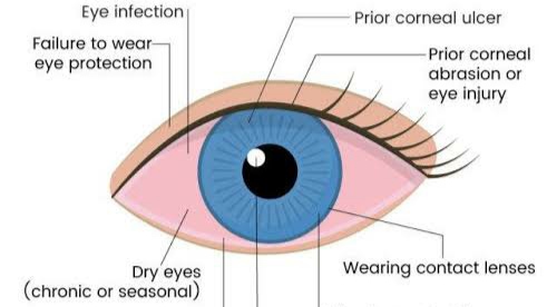 Corneal ulcer: Approach to diagnosis and management video