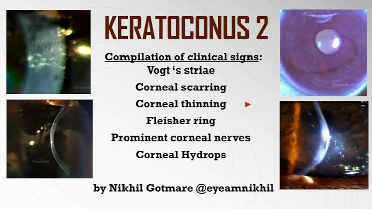 Keratoconus compilation of clinical signs- Vogt's striae, Fleischer ring, Hydrops video