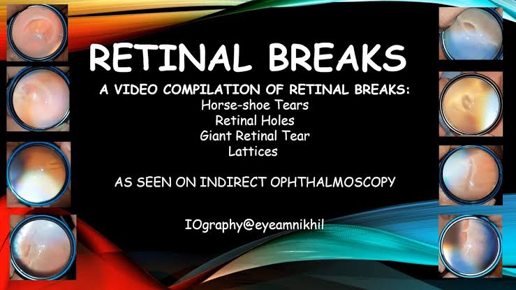 Retinal breaks as seen on indirect ophthalmoscopy video